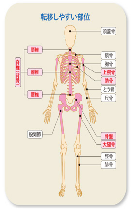 骨 転移 症状